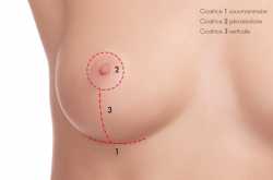 cost of breast reduction surgery in nigeria » lightup info