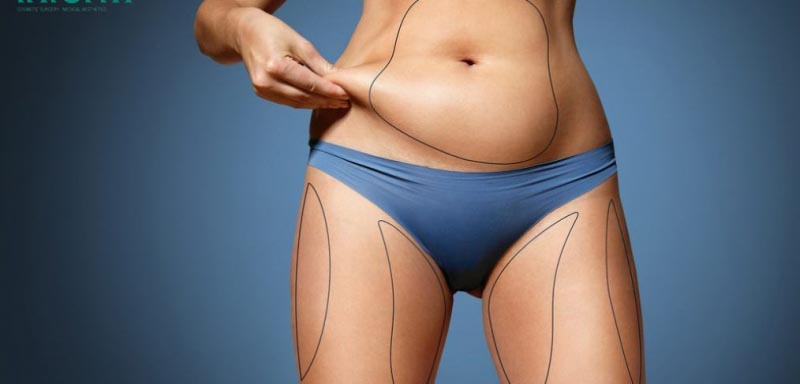 Cost Of Liposuction In Nigeria » Lightup Info