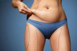 Cost of Liposuction in Nigeria » Lightup Info