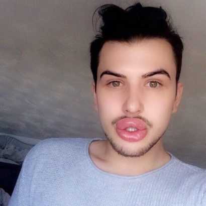 Crazy Kylie Jenner Fan Spends 6.7 Million Naira To Get His Lips Done To Look Like Kylie Jenner
