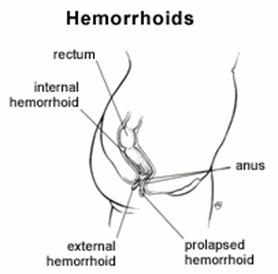 Curing Hemorrhoids In 48 Hours At Home