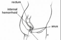 Curing Hemorrhoids in 48 Hours at Home
