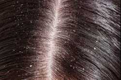 Dandruff - Home Remedies