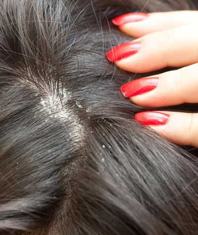 Dandruffed? Stop Scratching Your Scalp With Homeopathy