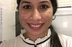 dealing with acne -30 days update