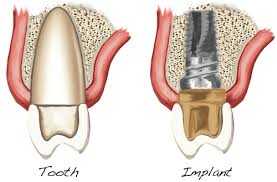 Dental Implants In India