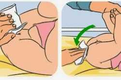 Diaper Rash: Five questions answered by Dermatologist