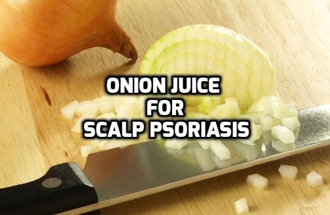 Does Onion Juice Helps In Scalp Psoriasis? - Psoriasis Self Management