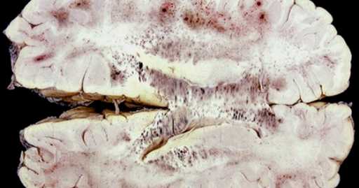 Drug Treatment Has Profound Effect On Cerebral Malaria In Mice