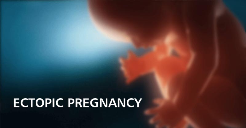Ectopic Pregnancy | MaxCure Suyosha