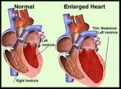 Enlarged Heart (cardiomegaly) : Causes, Symptoms, Tests & Diagnosis.