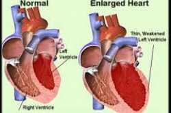 Enlarged heart (cardiomegaly) : Causes, Symptoms, Tests & Diagnosis.