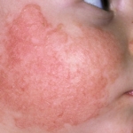 Fed Up With Those Red Chapped Cheeks Of Your Baby?