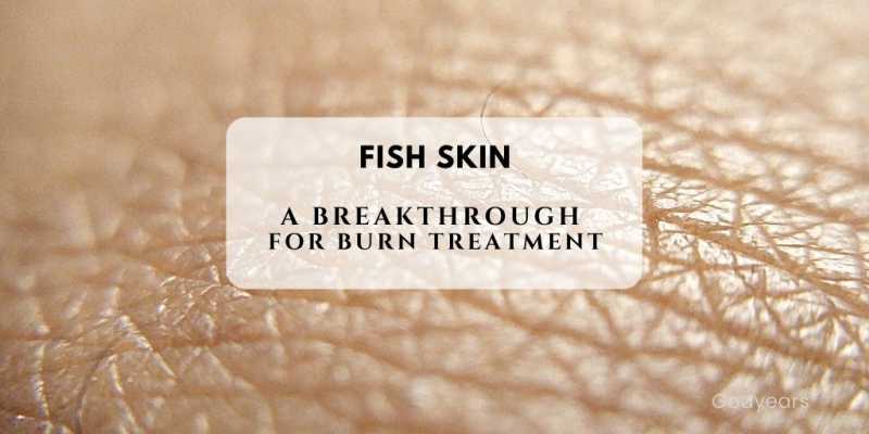 Fish Skin: A Breakthrough For Burn Treatment