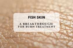 Fish skin: A breakthrough for burn treatment