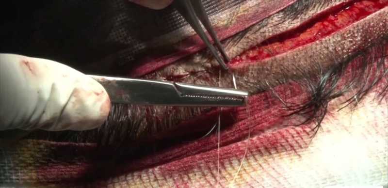 Follicular Unit Transplantation (FUT)