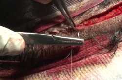 Follicular Unit Transplantation (FUT)