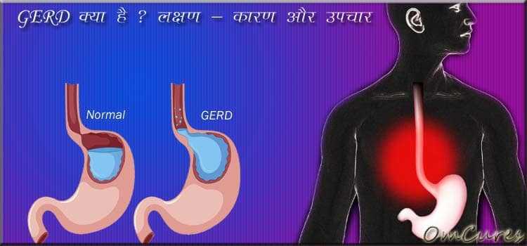 GERD In Hindi | GERD क्या है ? इसके लक्षण - कारण और Treatment