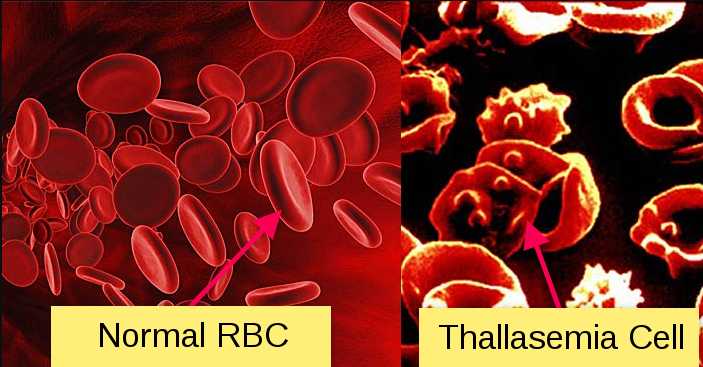 Genetics Of Thallasemia | Science Of Bio Genetics