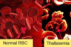 genetics of thallasemia | science of bio genetics