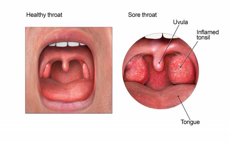 Get All Your Queries Answered About Sore Throat In This Sore Throat FAQs List !