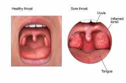 Get all your queries answered about Sore Throat in this Sore Throat FAQs list !