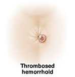 Getting Hemorrhoids Relief At Home
