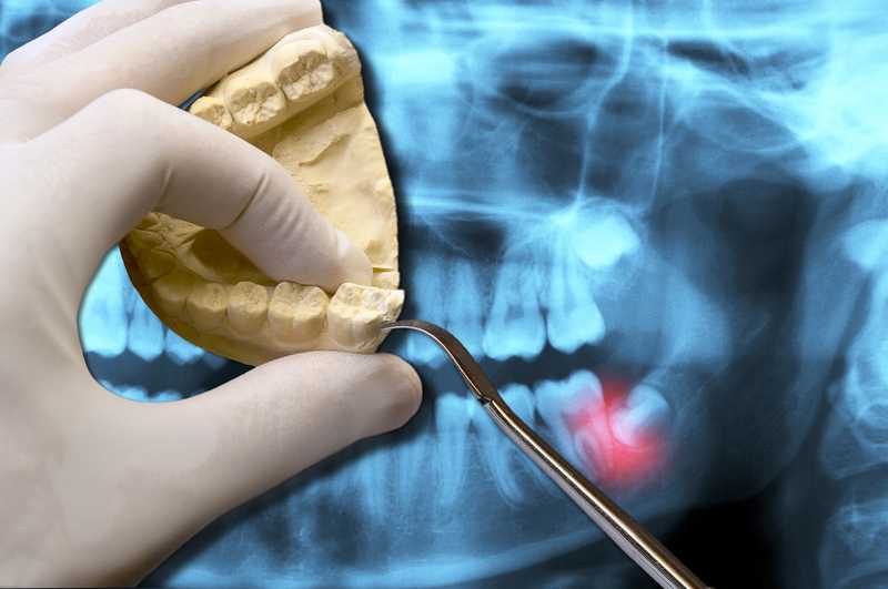 Getting Your Wisdom Teeth Removed? Read This