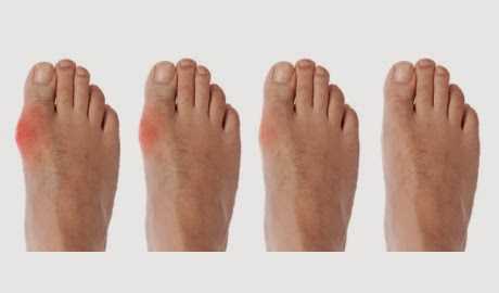 Gout | Cause, Signs & Symptoms Treatment & Homeopathy