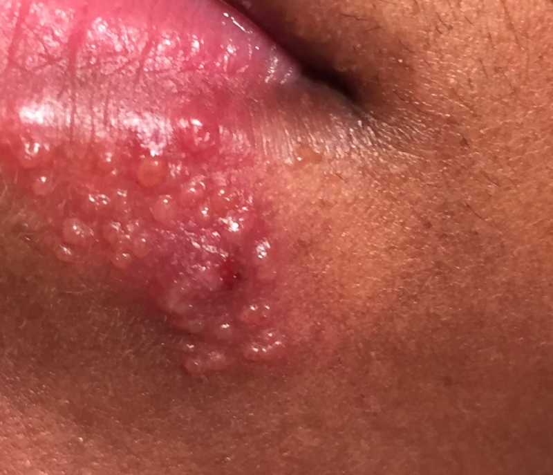 HERPES LABIALIS: COLD SORE, FEVER BLISTER ,TESTs AND TREATMENT