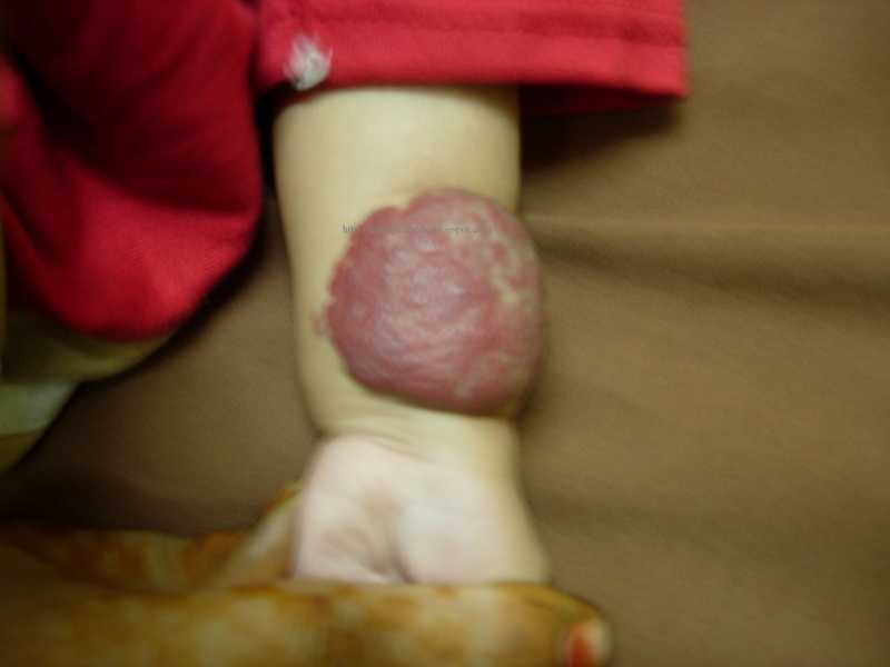 Haemangioma Over Forearm