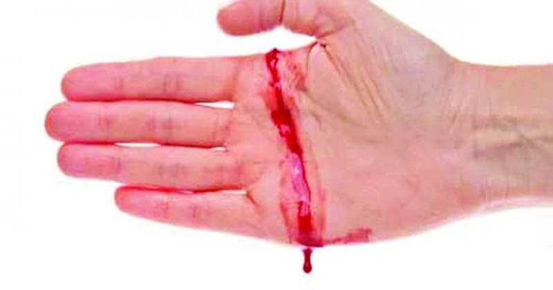 Hemophilia à¤¹à¥à¤®à¥à¤«à¤¿à¤²à¤¿à¤¯à¤¾