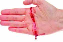 Hemophilia à¤¹à¥à¤®à¥à¤«à¤¿à¤²à¤¿à¤¯à¤¾