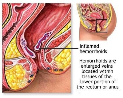 Hemorrhoids - Important Information One Must Know