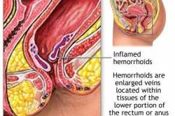 Hemorrhoids - Important Information One Must Know