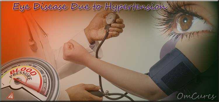 High Blood Pressure Eyes In Hindi | हाई ब्लड प्रेशर के कारण आँखों की बीमारी