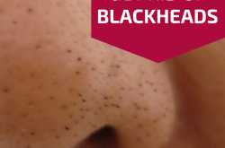 Home Remedies for Blackheads