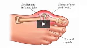 Home Remedies For Reducing Uric Acid