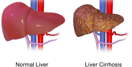 How To Cure Cirrhosis Of The Liver Naturally - Doctor Curex
