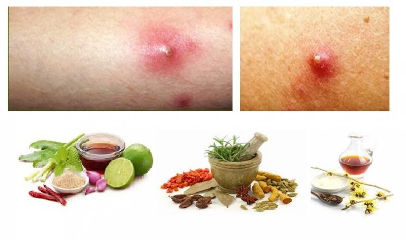 How To Get Rid Of Boils Fast - 10 Home Remedies For Boils