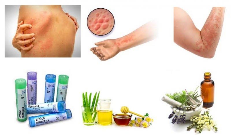How To Get Rid Of Hives Permanently - Home Remedies & Homeopathy