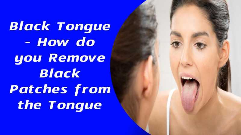 How Do You Remove Black Patches From The Tongue Symptoms Causes