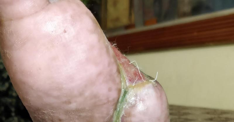 How My Father Leg Got Saved With Negative Pressure Wound Therapy