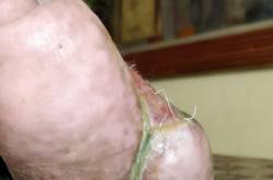 How my father leg got saved with Negative pressure wound therapy