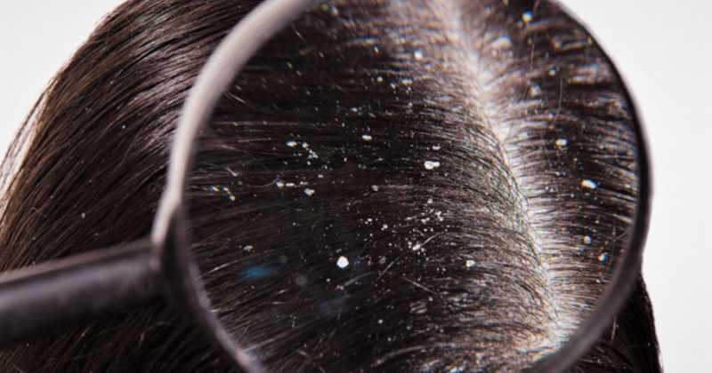 How To Get Rid Of Dandruff - 100% Working Home Remedies
