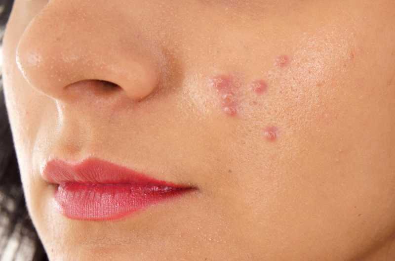 How To Get Rid Of An Acne Breakout Fast (and Prevent Future Ones)