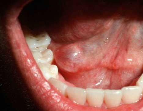 How To Get Rid Of Mucous Cyst?: 10 Home Remedies For Mucous Cysts