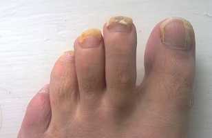 How To Get Rid Of Foot Fungus - Gyan Share