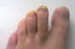How to Get Rid of Foot Fungus - Gyan Share