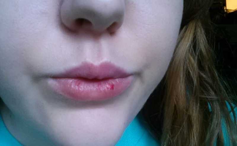 How To Get Rid Of Chapped Lips